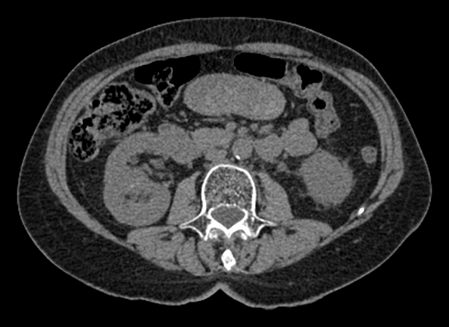 Tomografia de abdome sem contraste, corte axial em L3, como o exame foi adquirido